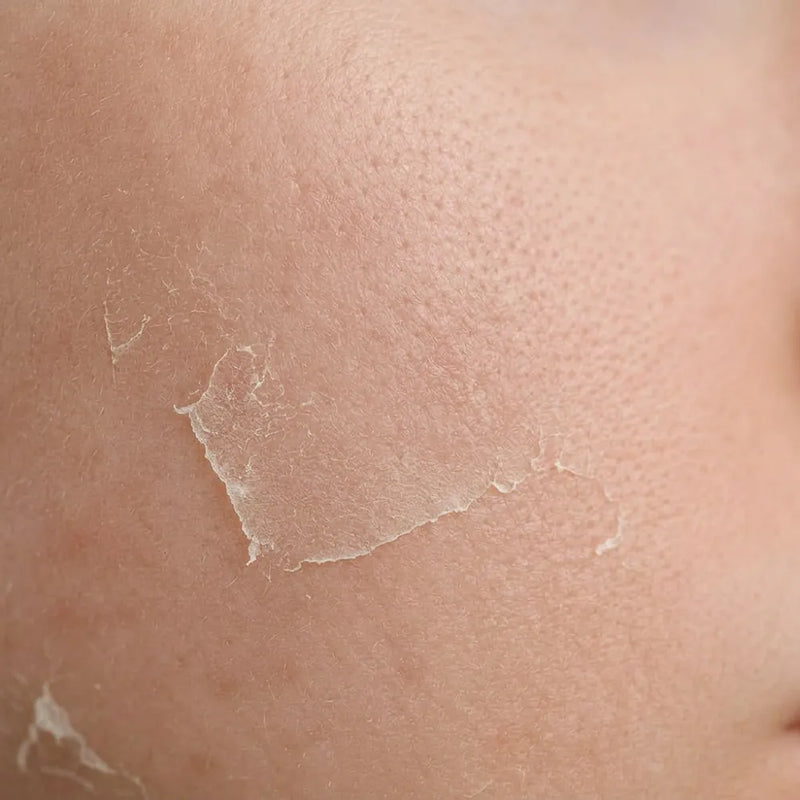 <p><strong>Peau sèche</strong></p>