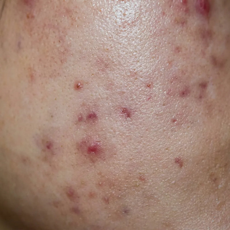 <p>Peau à imperfections</p>