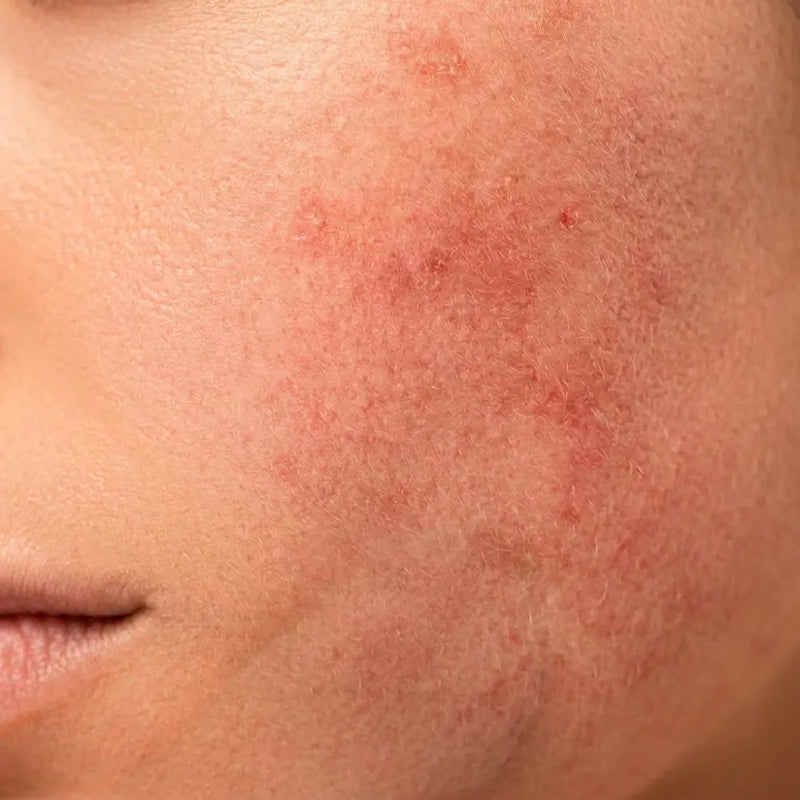 <p>Peau sensible</p>